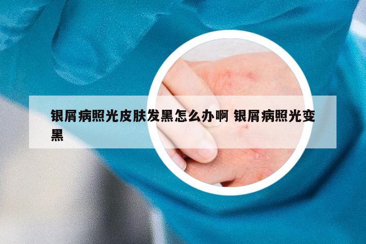 银屑病照光皮肤发黑怎么办啊 银屑病照光变黑