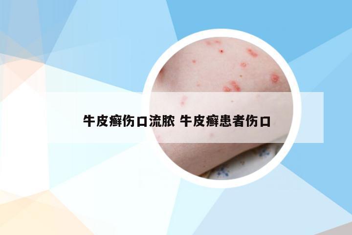 牛皮癣伤口流脓 牛皮癣患者伤口