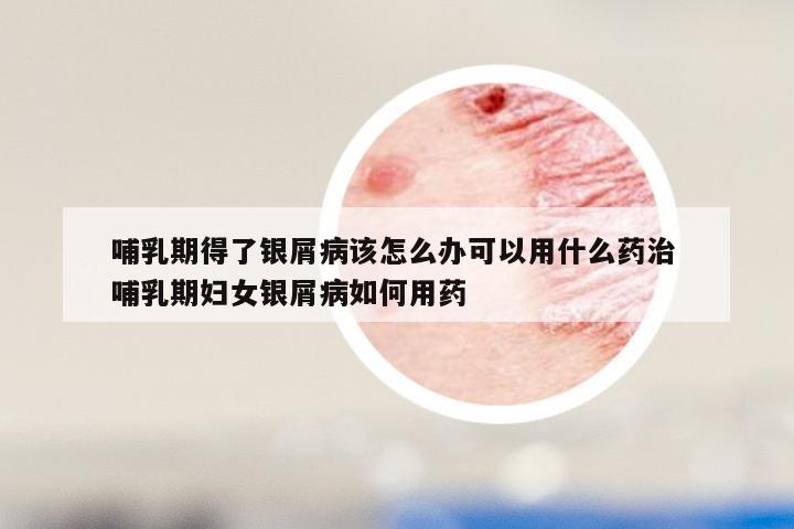 哺乳期得了银屑病该怎么办可以用什么药治 哺乳期妇女银屑病如何用药