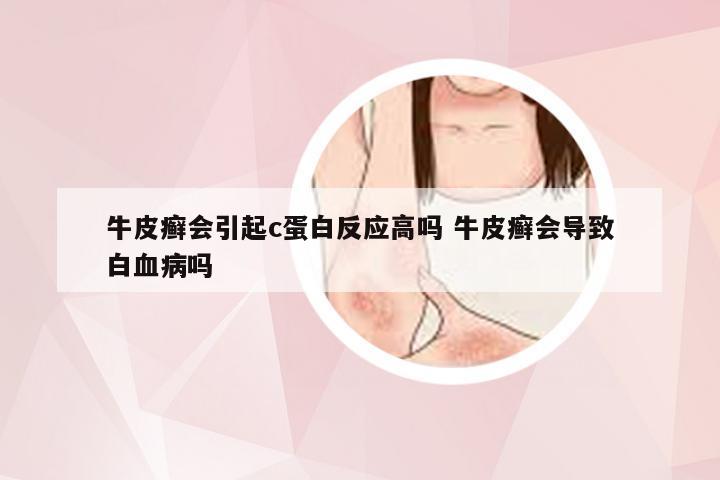 牛皮癣会引起c蛋白反应高吗 牛皮癣会导致白血病吗