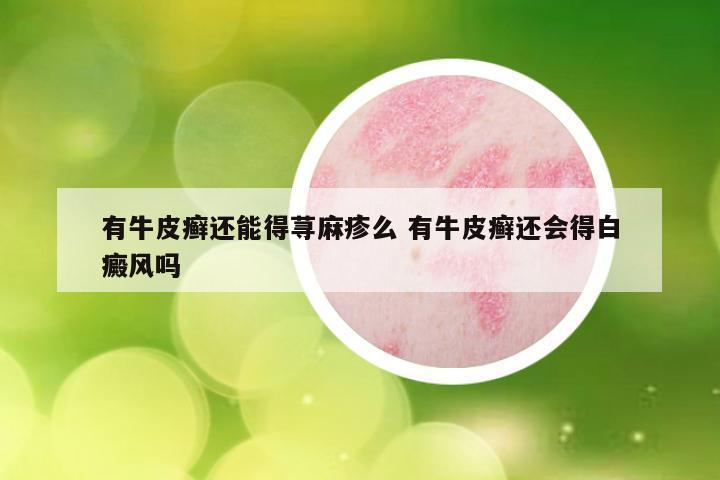 有牛皮癣还能得荨麻疹么 有牛皮癣还会得白癜风吗