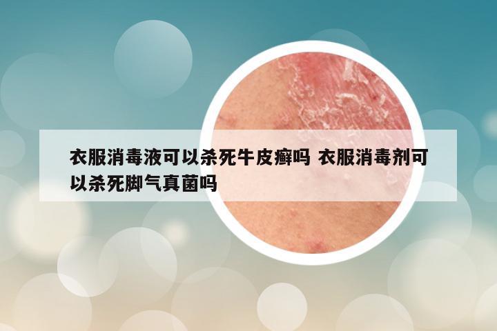 衣服消毒液可以杀死牛皮癣吗 衣服消毒剂可以杀死脚气真菌吗