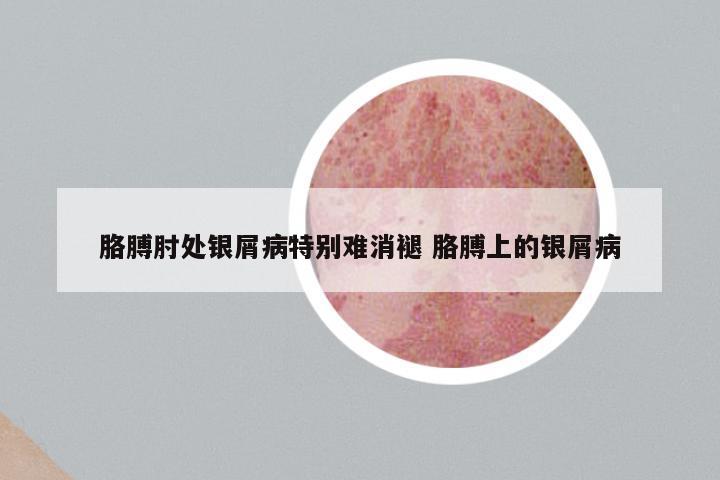 胳膊肘处银屑病特别难消褪 胳膊上的银屑病