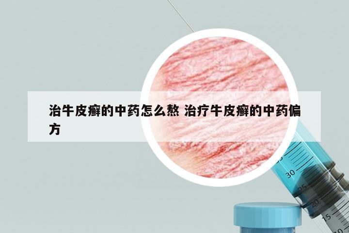 治牛皮癣的中药怎么熬 治疗牛皮癣的中药偏方