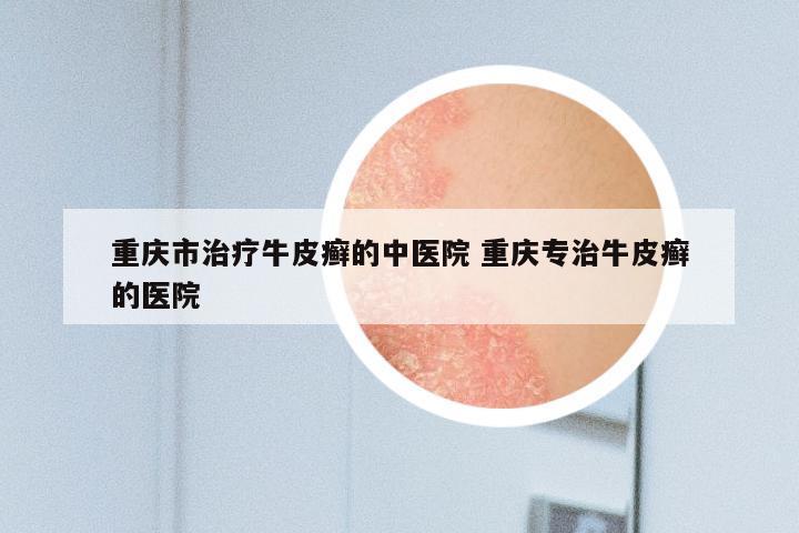 重庆市治疗牛皮癣的中医院 重庆专治牛皮癣的医院