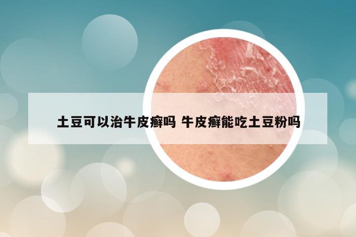 土豆可以治牛皮癣吗 牛皮癣能吃土豆粉吗