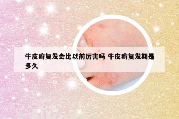 牛皮癣复发会比以前厉害吗 牛皮癣复发期是多久