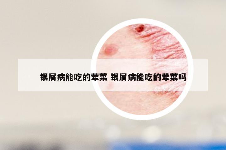 银屑病能吃的荤菜 银屑病能吃的荤菜吗