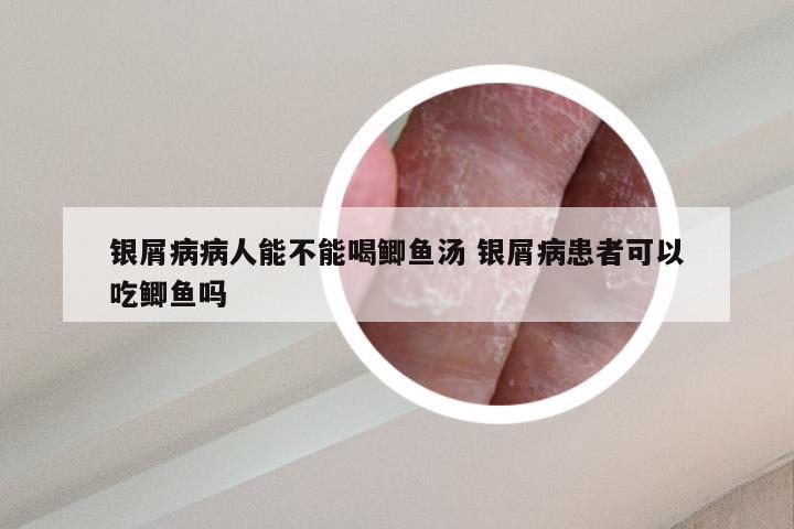 银屑病病人能不能喝鲫鱼汤 银屑病患者可以吃鲫鱼吗