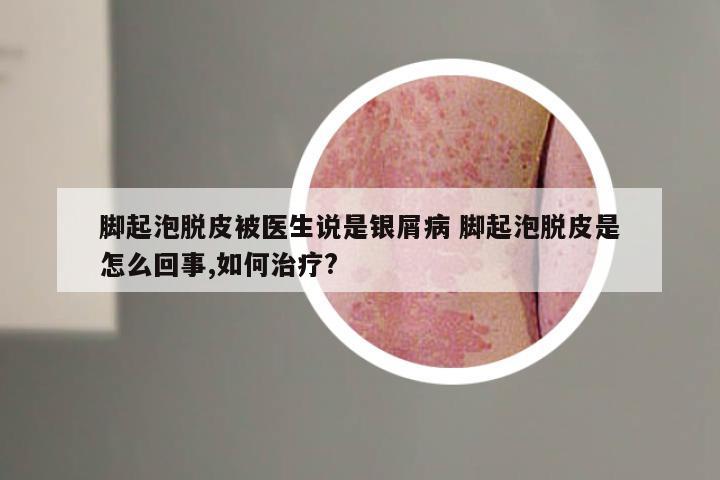 脚起泡脱皮被医生说是银屑病 脚起泡脱皮是怎么回事,如何治疗?