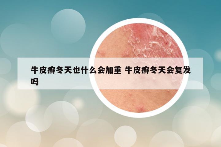 牛皮癣冬天也什么会加重 牛皮癣冬天会复发吗
