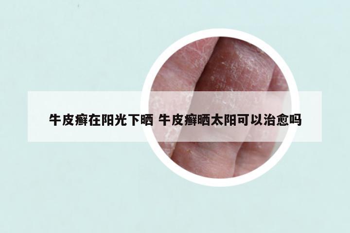 牛皮癣在阳光下晒 牛皮癣晒太阳可以治愈吗