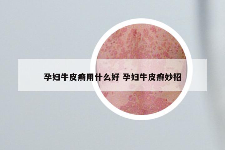 孕妇牛皮癣用什么好 孕妇牛皮癣妙招