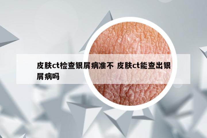 皮肤ct检查银屑病准不 皮肤ct能查出银屑病吗
