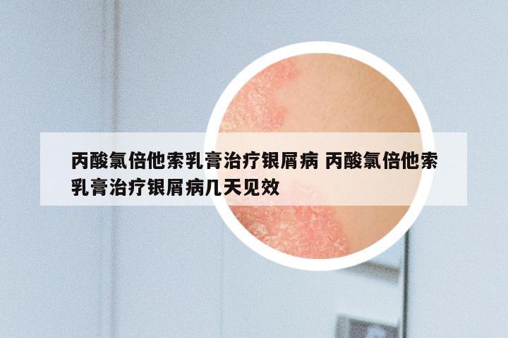 丙酸氯倍他索乳膏治疗银屑病 丙酸氯倍他索乳膏治疗银屑病几天见效