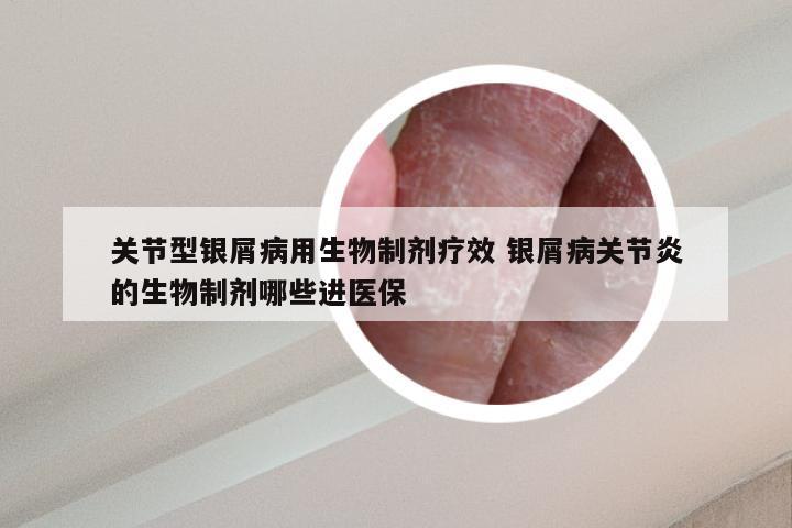 关节型银屑病用生物制剂疗效 银屑病关节炎的生物制剂哪些进医保