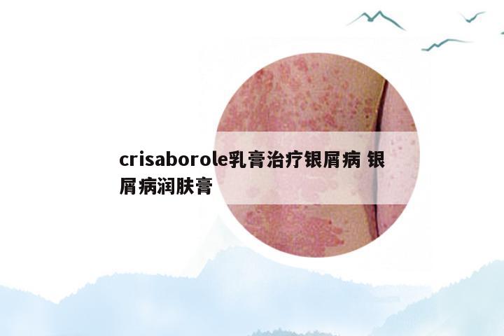 crisaborole乳膏治疗银屑病 银屑病润肤膏