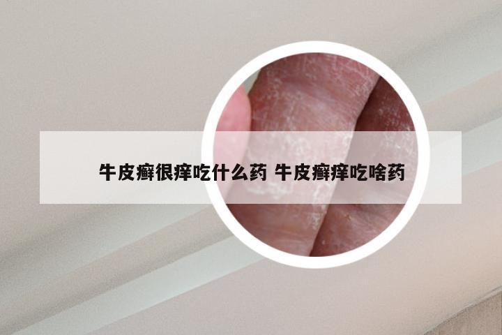 牛皮癣很痒吃什么药 牛皮癣痒吃啥药