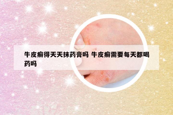 牛皮癣得天天抹药膏吗 牛皮癣需要每天都喝药吗