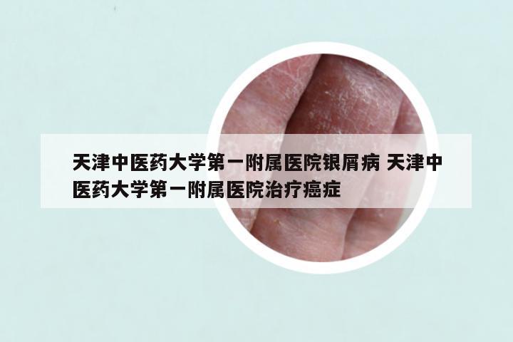 天津中医药大学第一附属医院银屑病 天津中医药大学第一附属医院治疗癌症