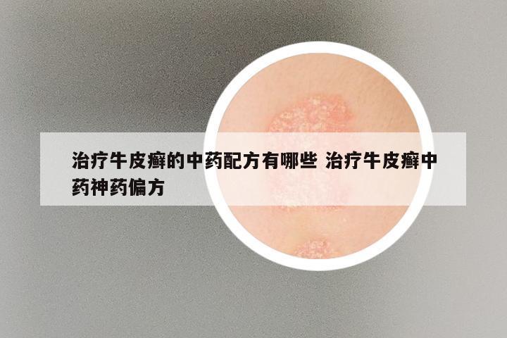 治疗牛皮癣的中药配方有哪些 治疗牛皮癣中药神药偏方