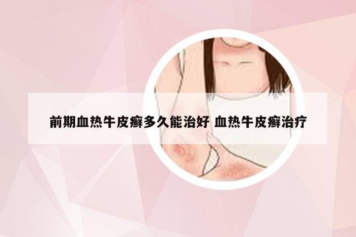 前期血热牛皮癣多久能治好 血热牛皮癣治疗