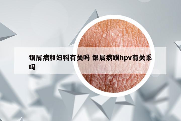 银屑病和妇科有关吗 银屑病跟hpv有关系吗