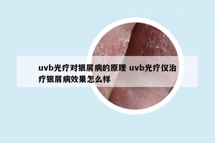 uvb光疗对银屑病的原理 uvb光疗仪治疗银屑病效果怎么样