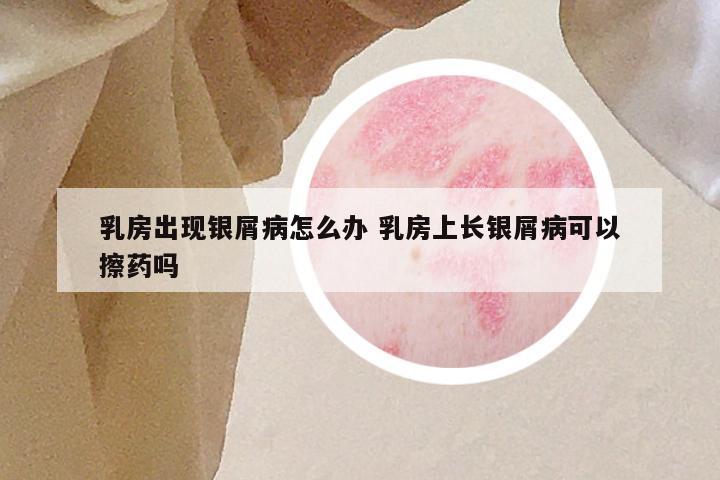乳房出现银屑病怎么办 乳房上长银屑病可以擦药吗