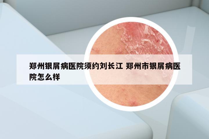 郑州银屑病医院须约刘长江 郑州市银屑病医院怎么样