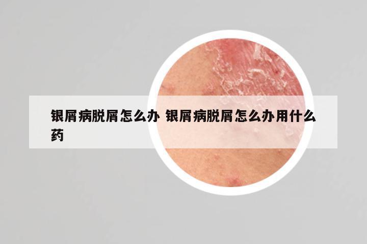 银屑病脱屑怎么办 银屑病脱屑怎么办用什么药