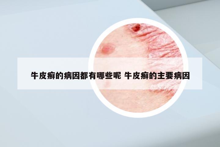 牛皮癣的病因都有哪些呢 牛皮癣的主要病因