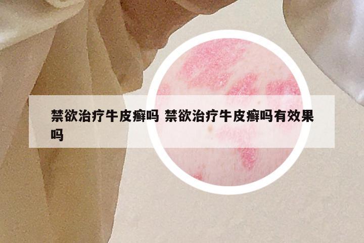 禁欲治疗牛皮癣吗 禁欲治疗牛皮癣吗有效果吗