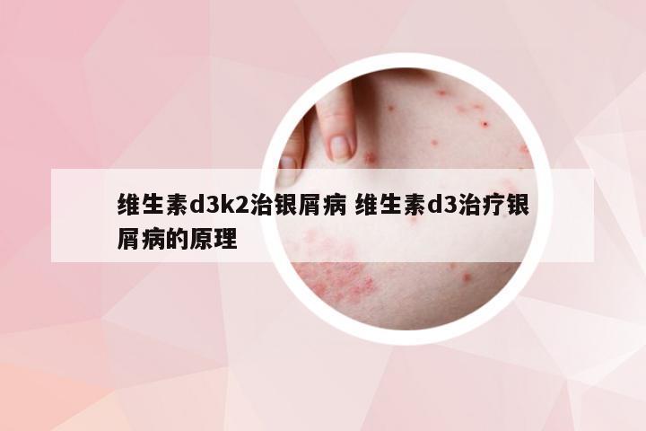 维生素d3k2治银屑病 维生素d3治疗银屑病的原理