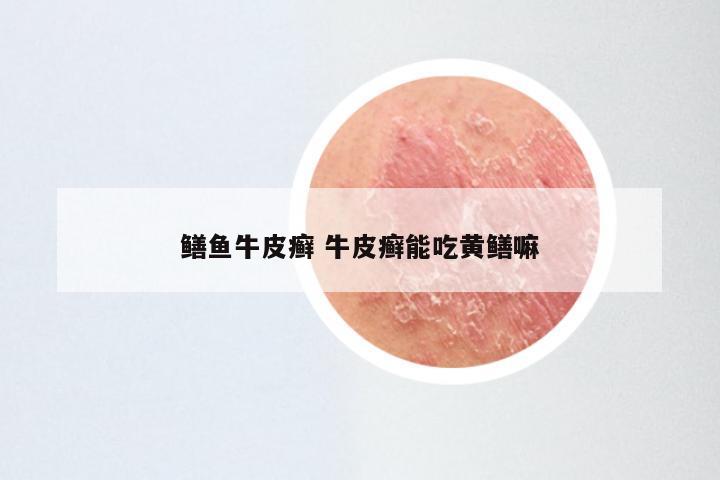 鳝鱼牛皮癣 牛皮癣能吃黄鳝嘛