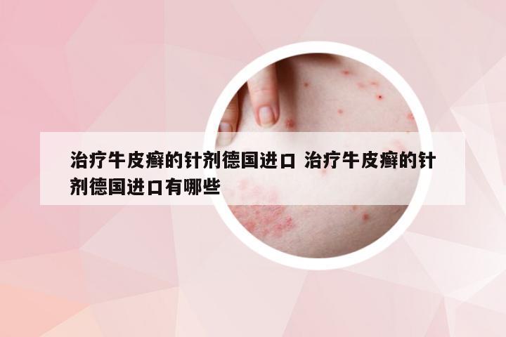 治疗牛皮癣的针剂德国进口 治疗牛皮癣的针剂德国进口有哪些