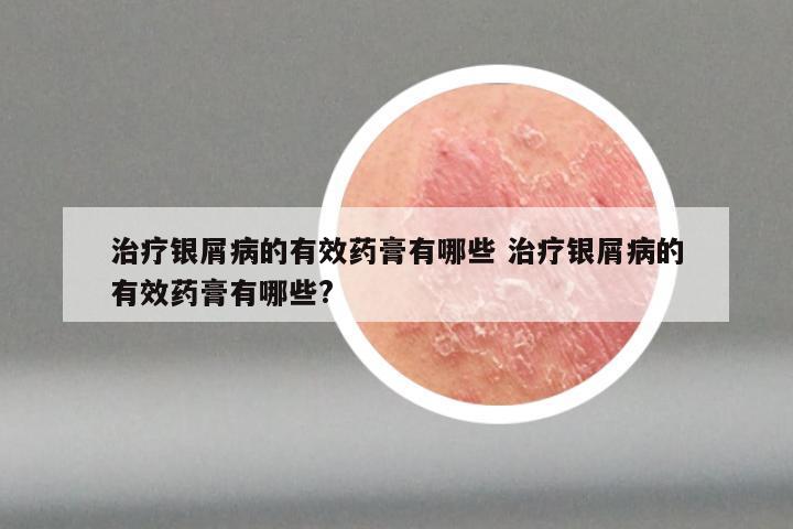 治疗银屑病的有效药膏有哪些 治疗银屑病的有效药膏有哪些?