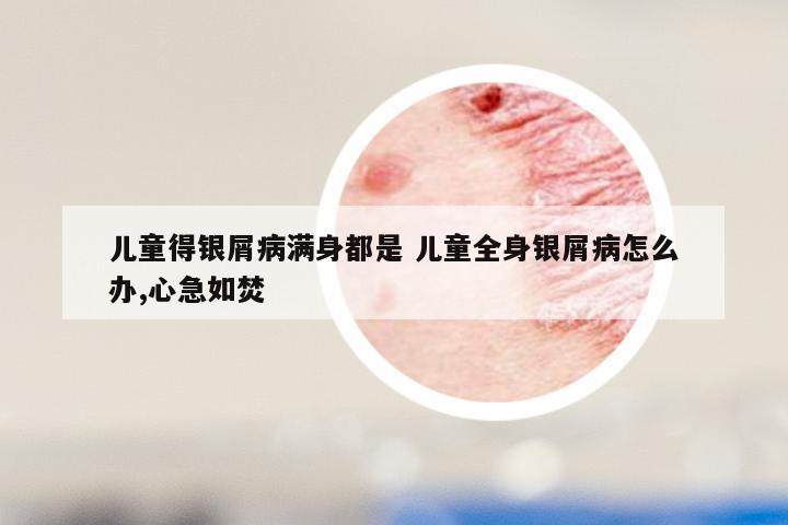 儿童得银屑病满身都是 儿童全身银屑病怎么办,心急如焚