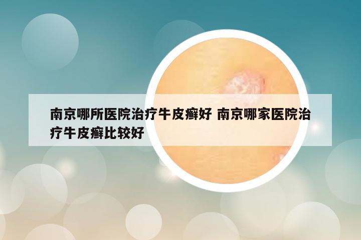 南京哪所医院治疗牛皮癣好 南京哪家医院治疗牛皮癣比较好