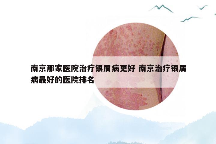 南京那家医院治疗银屑病更好 南京治疗银屑病最好的医院排名