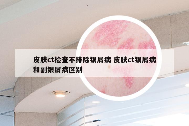 皮肤ct检查不排除银屑病 皮肤ct银屑病和副银屑病区别