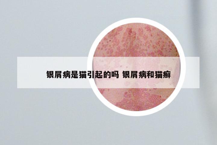 银屑病是猫引起的吗 银屑病和猫癣