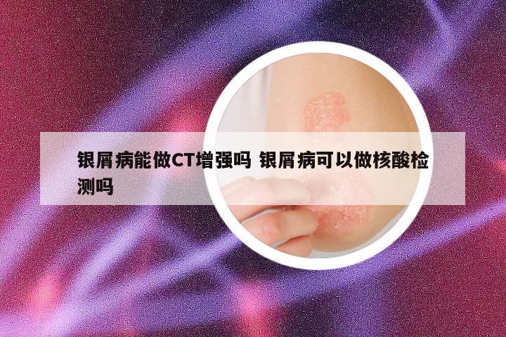 银屑病能做CT增强吗 银屑病可以做核酸检测吗