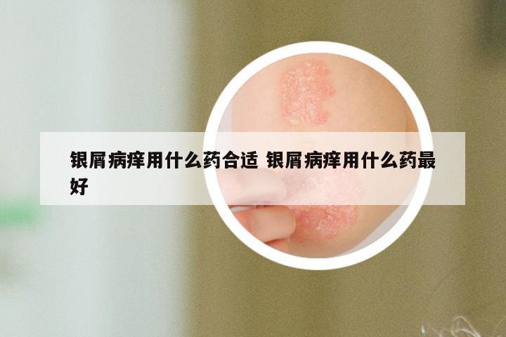 银屑病痒用什么药合适 银屑病痒用什么药最好