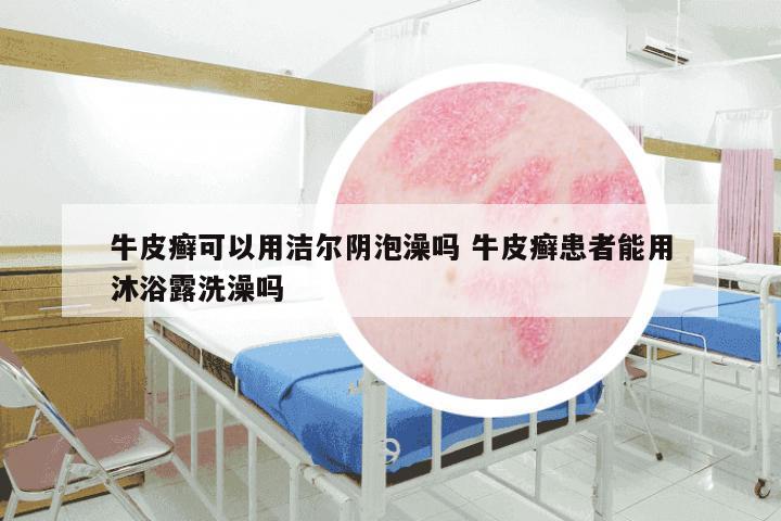 牛皮癣可以用洁尔阴泡澡吗 牛皮癣患者能用沐浴露洗澡吗