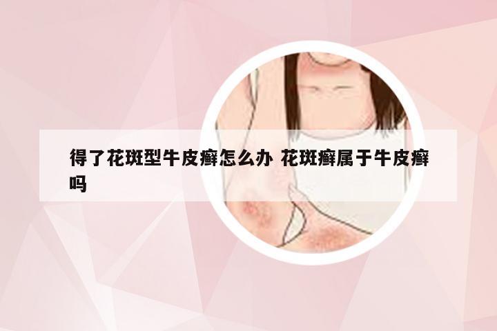 得了花斑型牛皮癣怎么办 花斑癣属于牛皮癣吗