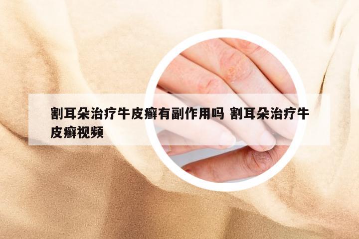 割耳朵治疗牛皮癣有副作用吗 割耳朵治疗牛皮癣视频