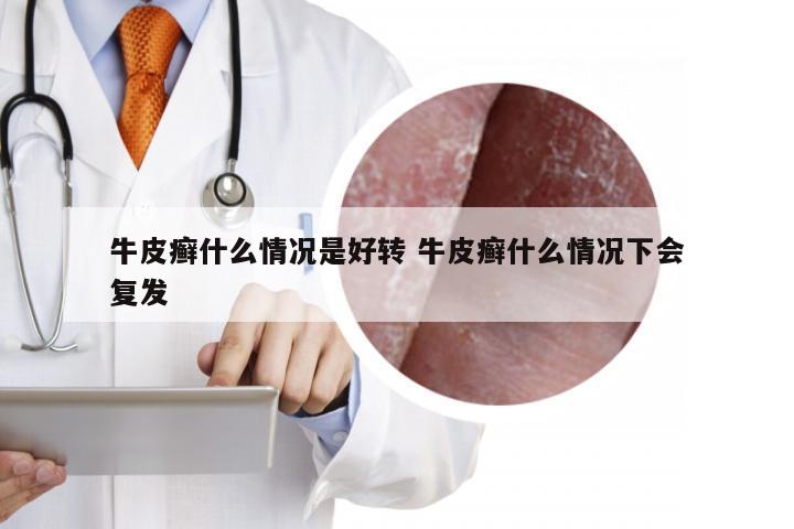牛皮癣什么情况是好转 牛皮癣什么情况下会复发