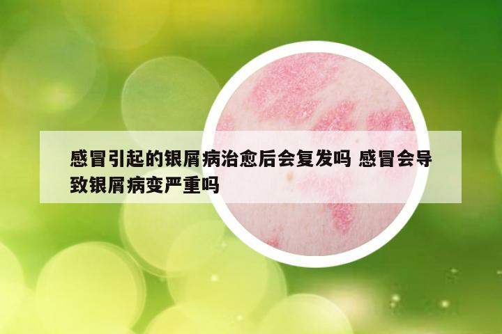 感冒引起的银屑病治愈后会复发吗 感冒会导致银屑病变严重吗