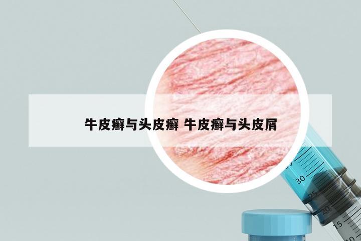 牛皮癣与头皮癣 牛皮癣与头皮屑